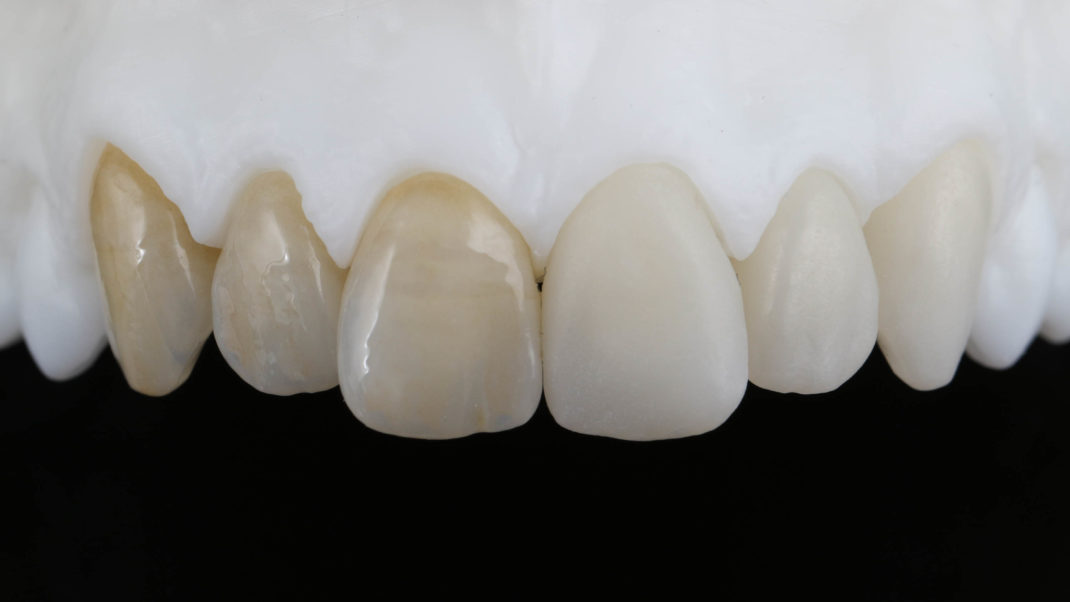 Zirlux Anterior Multi bridge