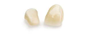 Zirlux zirconia crowns